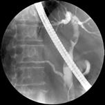 ERCP