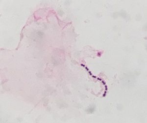 髄液中のレンサ球菌